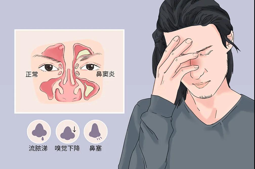 上 鼻窦炎会给大家生活带来一系列麻烦 而想要预防鼻窦炎疾病